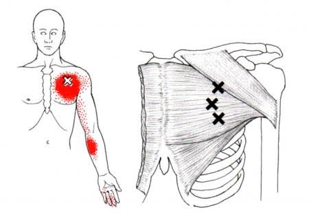 Trigger Points on Sholder